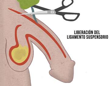 Alargamiento de Pene ligamiento suspensorio Cirugia para alargar el pene